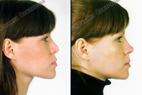 rinoplastic-5D7F8ADEB-8CD4-0B9C-C477-18D28B967E4D.jpg