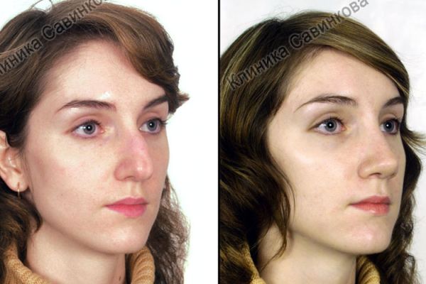 rinoplastic-6-1C13A4C11-7967-CB24-2F19-5047E8E3FBAC.jpg
