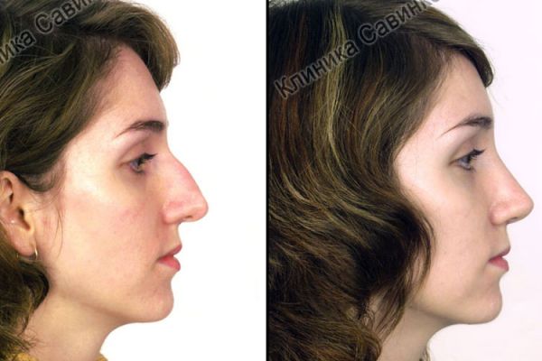 rinoplastic-66B78D988-7F2E-D7FF-E34D-554BD5EB36AB.jpg