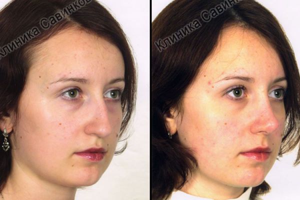 rinoplastic-7-1CC8875FE-9924-2A09-3673-20EDCC3B6506.jpg