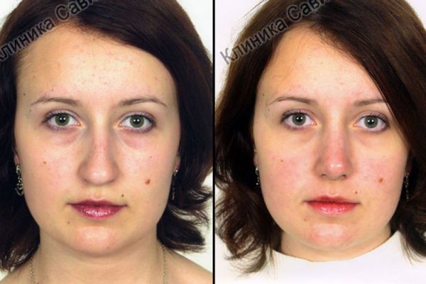 rinoplastic-7-277EBEB59-FD6F-ED3E-CF46-9E012BD1BE5F.jpg