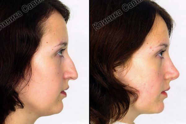 rinoplastic-73E3B9B16-E2E2-4C5E-8041-66EAFCA39700.jpg