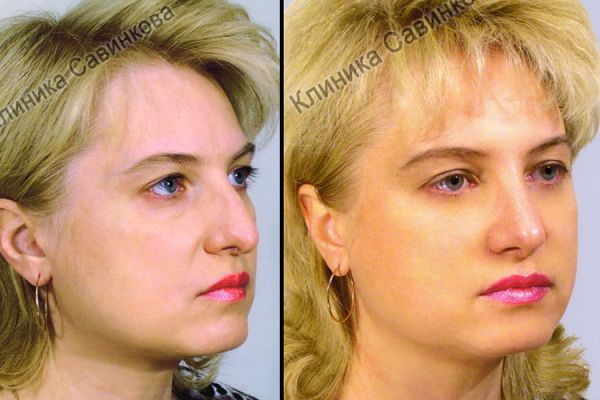 rinoplastic-8-15D74735B-5547-99EF-D7A0-472CAA5B27A8.jpg