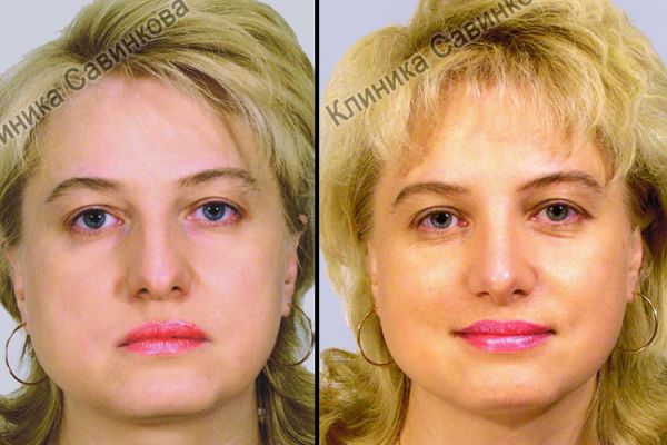 rinoplastic-8-23304CC82-F0B4-96A3-F4C7-CEC6B8592991.jpg