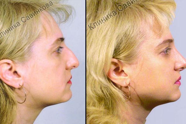 rinoplastic-822691725-73C4-1782-44D3-C56D00AAD927.jpg