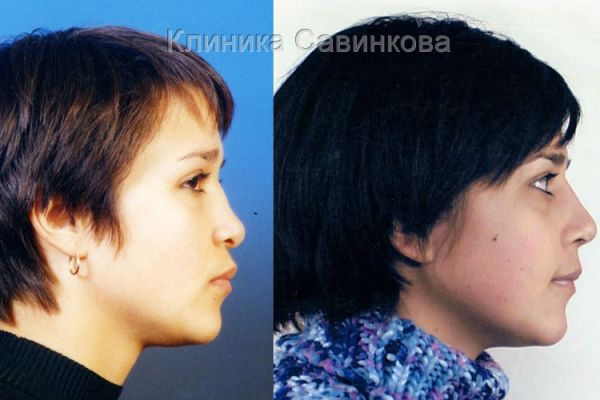 rinoplastic-9264B55E3-DD0F-A284-BF52-BC1C58D4786E.jpg