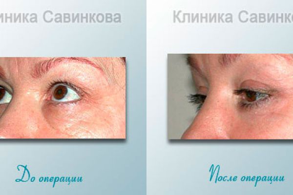 blefaroplastica-102ADFED8B-F912-FCA1-AF4B-095D08FEAA76.jpg