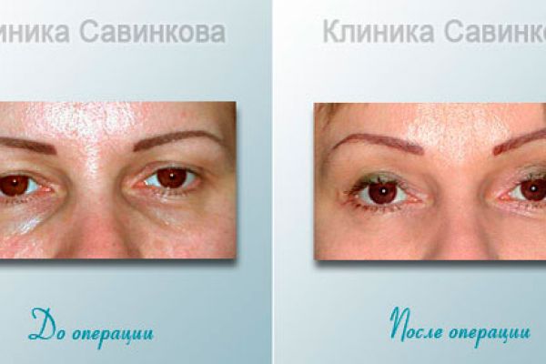 blefaroplastica-2B5B49865-6BCF-D327-D27B-4613847364BF.jpg