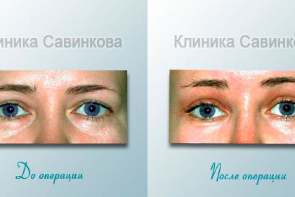 blefaroplastica-50C54FBDF-EE9F-491A-0D88-30AB6DC67C82.jpg