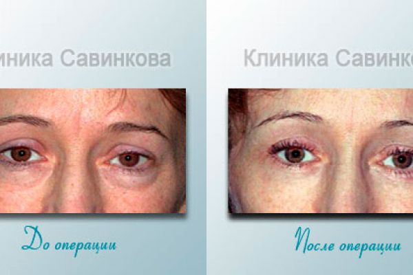 blefaroplastica-687EAD25F-B97E-F01C-67CC-38F233C44ACD.jpg