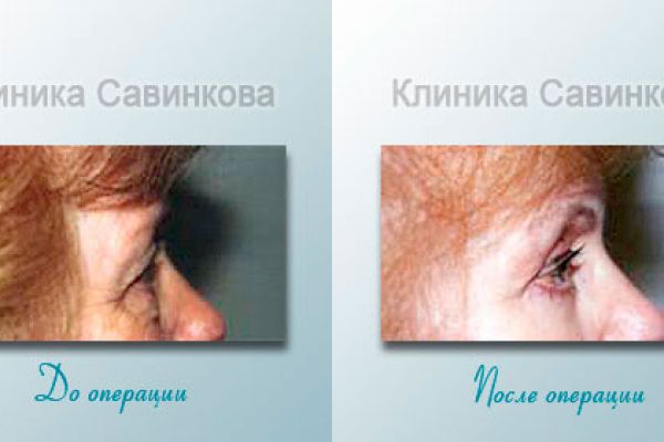 blefaroplastica-8-1753655FD-0492-C299-EC3B-CE81725C1830.jpg