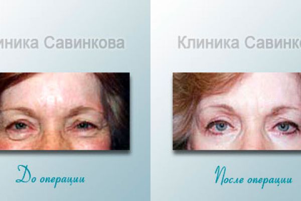 blefaroplastica-8BE1D13E5-F2E8-B90D-AAC2-0178BD417450.jpg