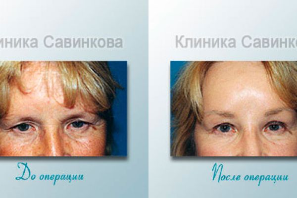 blefaroplastica-9CE9FC8A8-2FC4-177F-190A-68A9D28ED936.jpg