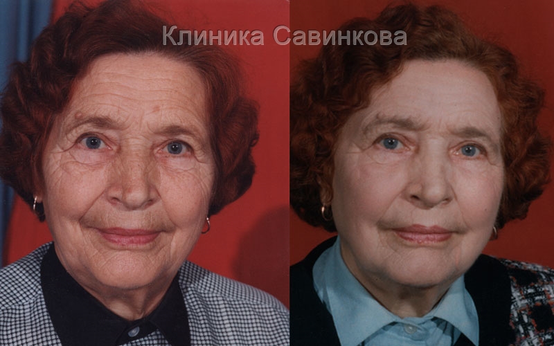 Маска молодости (омоложение лица без операции)